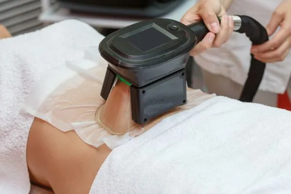 Image of person having fat freezing treatment to help weight gain Ilford