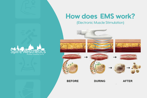 EMS treatment for post pregnancy weight loss treatment Ilford