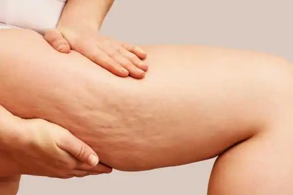 Image of woman showing leg with cellulite Ilford