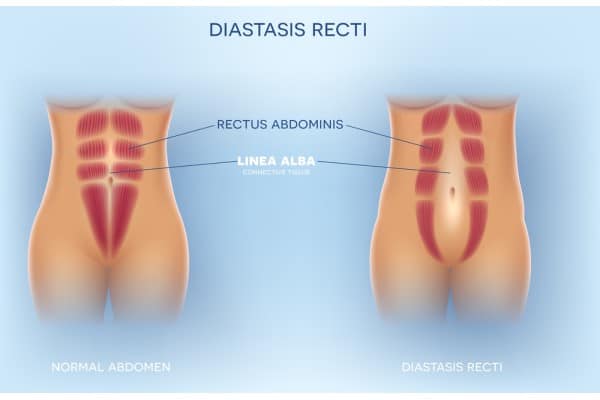 How Does Non-Surgical Treatment Help With Loose Skin, Weak Abdominal Muscles and Post-Pregnancy Changes Ilford?