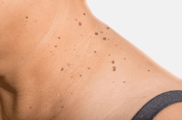 Are you looking for easy skin tag removal Ilford - then contact Spire today!