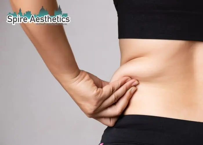 Image of woman pinching fat on their hips Ilford. Fat Freezing treatment 