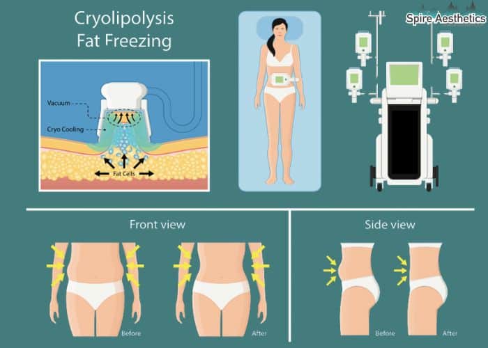 Image of diet and fat freezing combined for best results for Spire Aesthetics Ilford