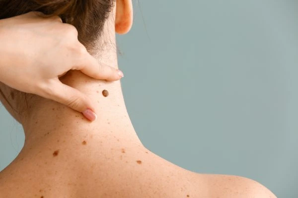 skin blemish removal Ilford treatment