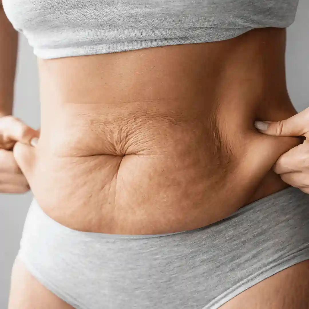 Is It Normal to Have Loose Skin After Pregnancy Ilford?