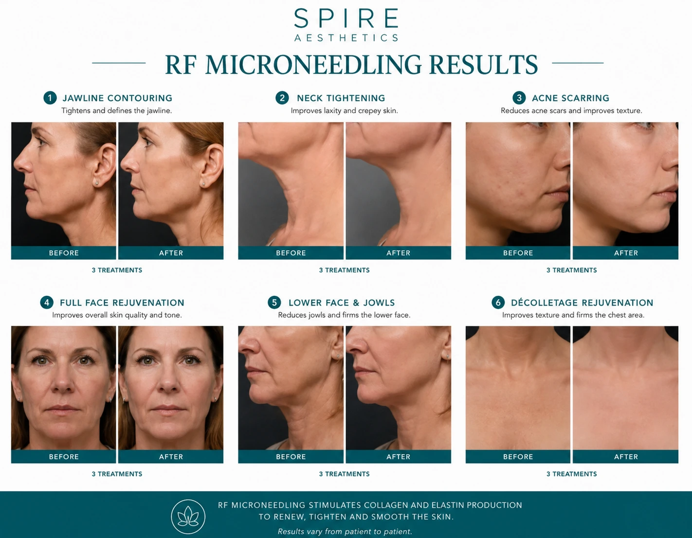 RF Microneedling Skin tightening Ilford results