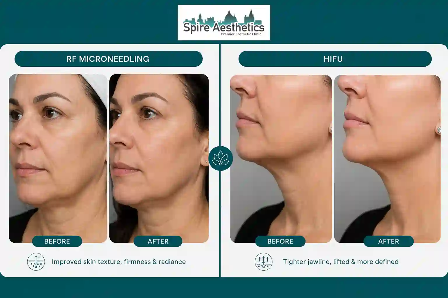 Can RF Microneedling and HIFU Be Combined Ilford?