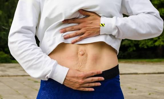When Could Diastasis Recti Be the Missing Piece of the Puzzle Ilford?