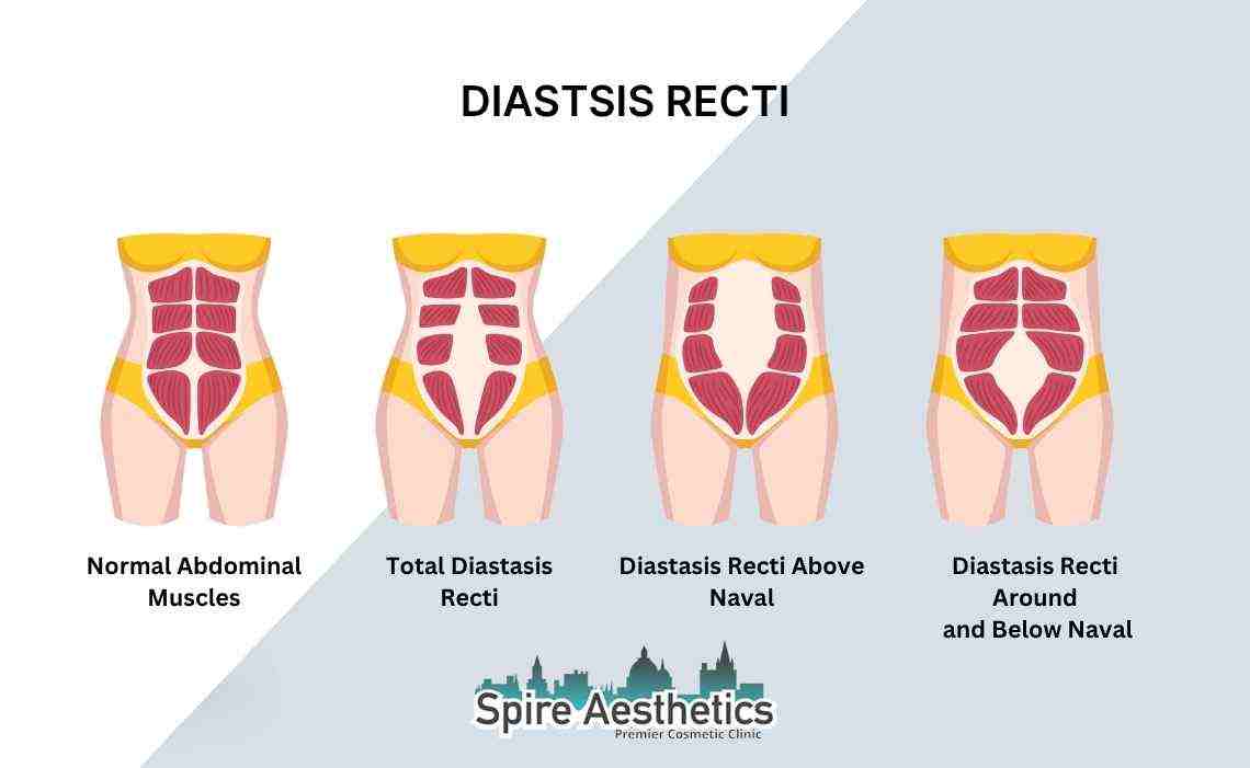 Is Non-Surgical Diastasis Recti Treatment Right for You? Common Concerns Answered Ilford